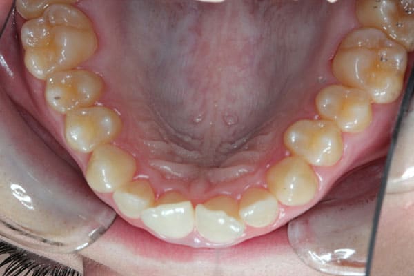 Best Invisalign 5 Dentist Kallangur
