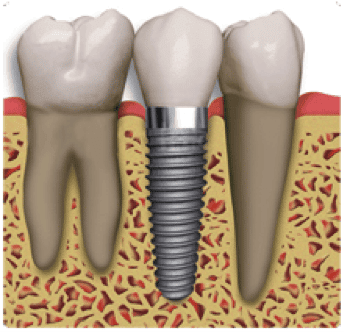Prevent Dental Suite | Implants - Dentist Kallangur