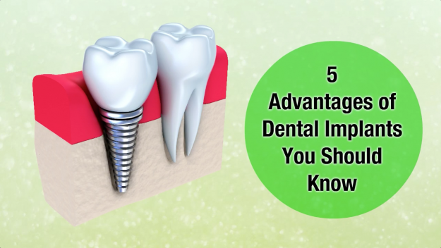 5_Advantages_of_Dental_Implants_in_Murrumba_Downs