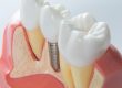 Kallangur Dentist Trivia Top 5 Myths about Dental Implants