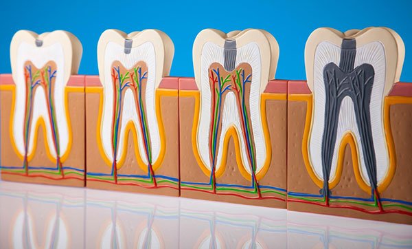 Prevent Dental Suite Tooth Decay | Dentist Kallangur
