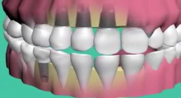 Prevent Dental Suite | Dental Implants Simplified Video | Dentist Kallangur