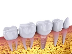 Affordable-Dental-Implants-in-Buderim