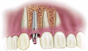 Affordable Dental Implants in Gympie Prevent Dental Suite