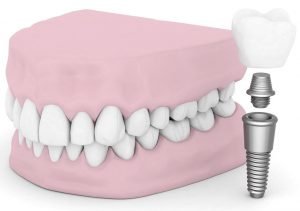 Affordable Dental Implants in Sunshine Coast Dentist Sunshine Coast