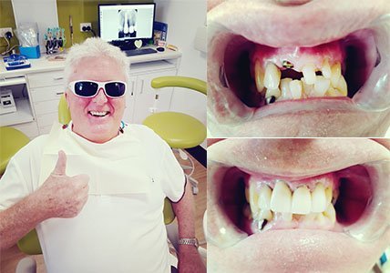 Dental-Implant-Happy-Customer-Dentist-Gympie