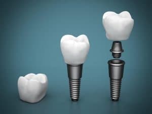 Dental-Implants-Dentist-Gladstone