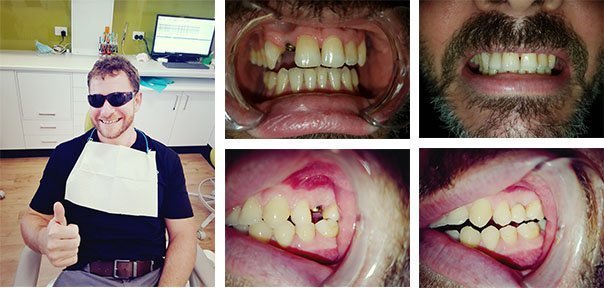 Dental-Implants-Placed-and-Happy-Customer-Dentist-Buderim
