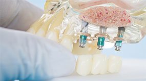 Dental Implants Home Widget Dentist Kallangur