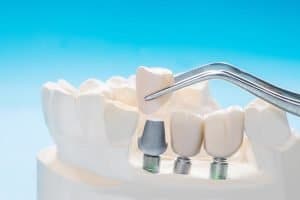 dental implants in redcliffe