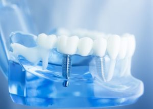 Which Is The Best Dentist For A Dental Emergency In Kallangur 1