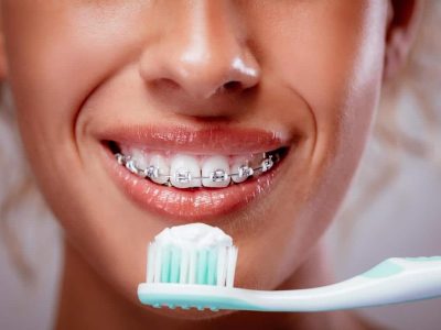 kallangur dentist tips how can I keep my teeth clean when wearing braces